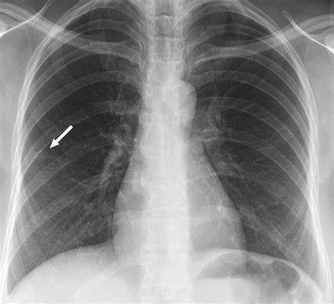 Tuberculosis Screening Model